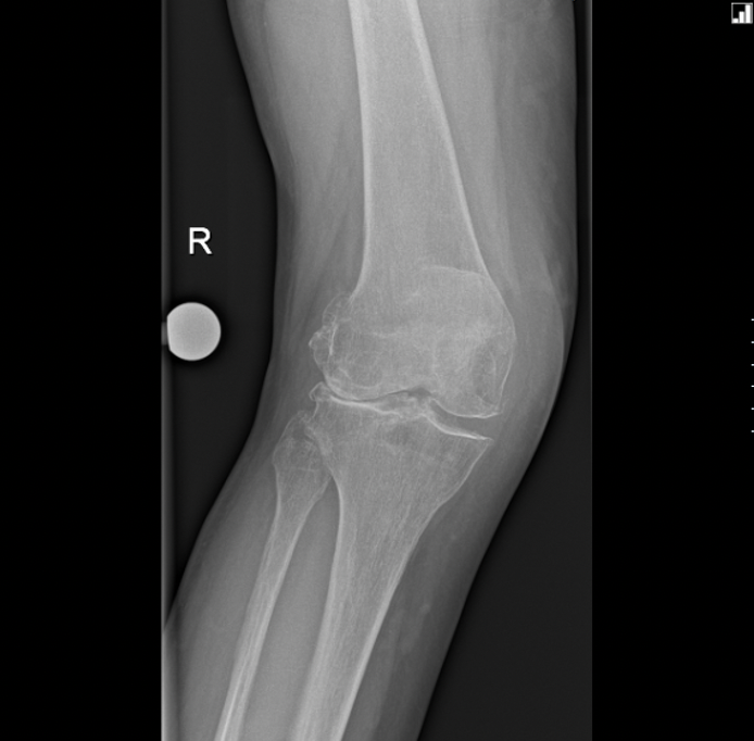 Knee Replacement Surgery Magill Orthopaedics